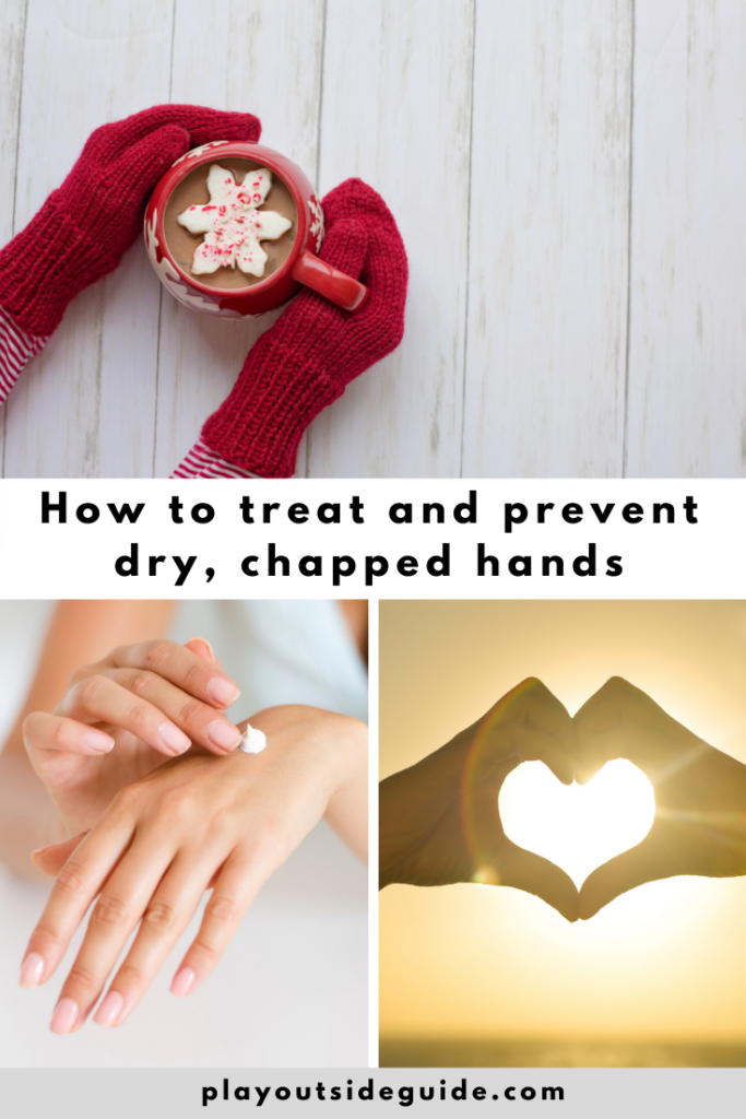 how to treat and prevent dry chapped hands